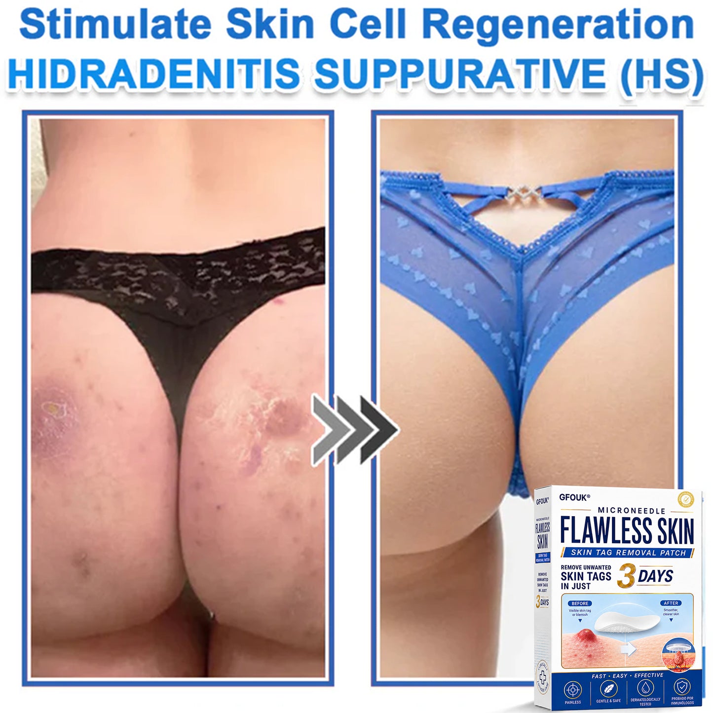 🔥GFOUK® 2026 Newly Upgraded 2-in-1 Microneedle Hydrocolloid Patches | Removes Raised Moles, Acne, Flat Warts, and Skin Tags | Improves Wrinkles, Scars, and Blemishes | Invisible Acne Patches for Face & Body