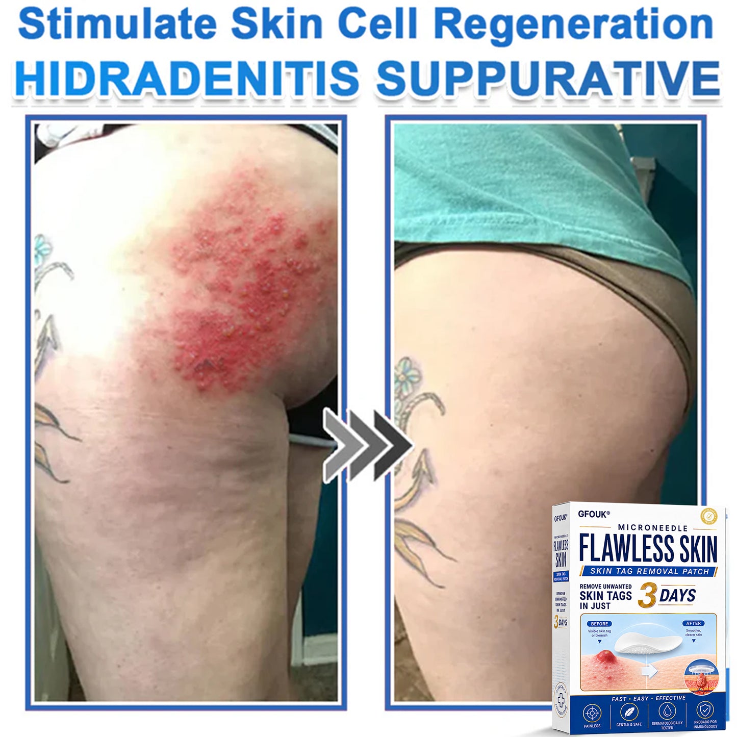🔥GFOUK® 2026 Newly Upgraded 2-in-1 Microneedle Hydrocolloid Patches | Removes Raised Moles, Acne, Flat Warts, and Skin Tags | Improves Wrinkles, Scars, and Blemishes | Invisible Acne Patches for Face & Body