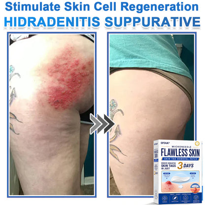 🔥GFOUK® 2026 Newly Upgraded 2-in-1 Microneedle Hydrocolloid Patches | Removes Raised Moles, Acne, Flat Warts, and Skin Tags | Improves Wrinkles, Scars, and Blemishes | Invisible Acne Patches for Face & Body