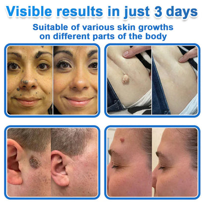 🔥GFOUK® 2026 Newly Upgraded 2-in-1 Microneedle Hydrocolloid Patches | Removes Raised Moles, Acne, Flat Warts, and Skin Tags | Improves Wrinkles, Scars, and Blemishes | Invisible Acne Patches for Face & Body
