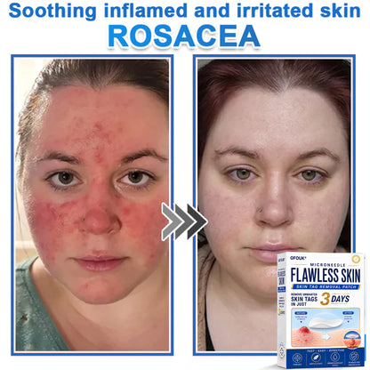 🔥GFOUK® 2026 Newly Upgraded 2-in-1 Microneedle Hydrocolloid Patches | Removes Raised Moles, Acne, Flat Warts, and Skin Tags | Improves Wrinkles, Scars, and Blemishes | Invisible Acne Patches for Face & Body