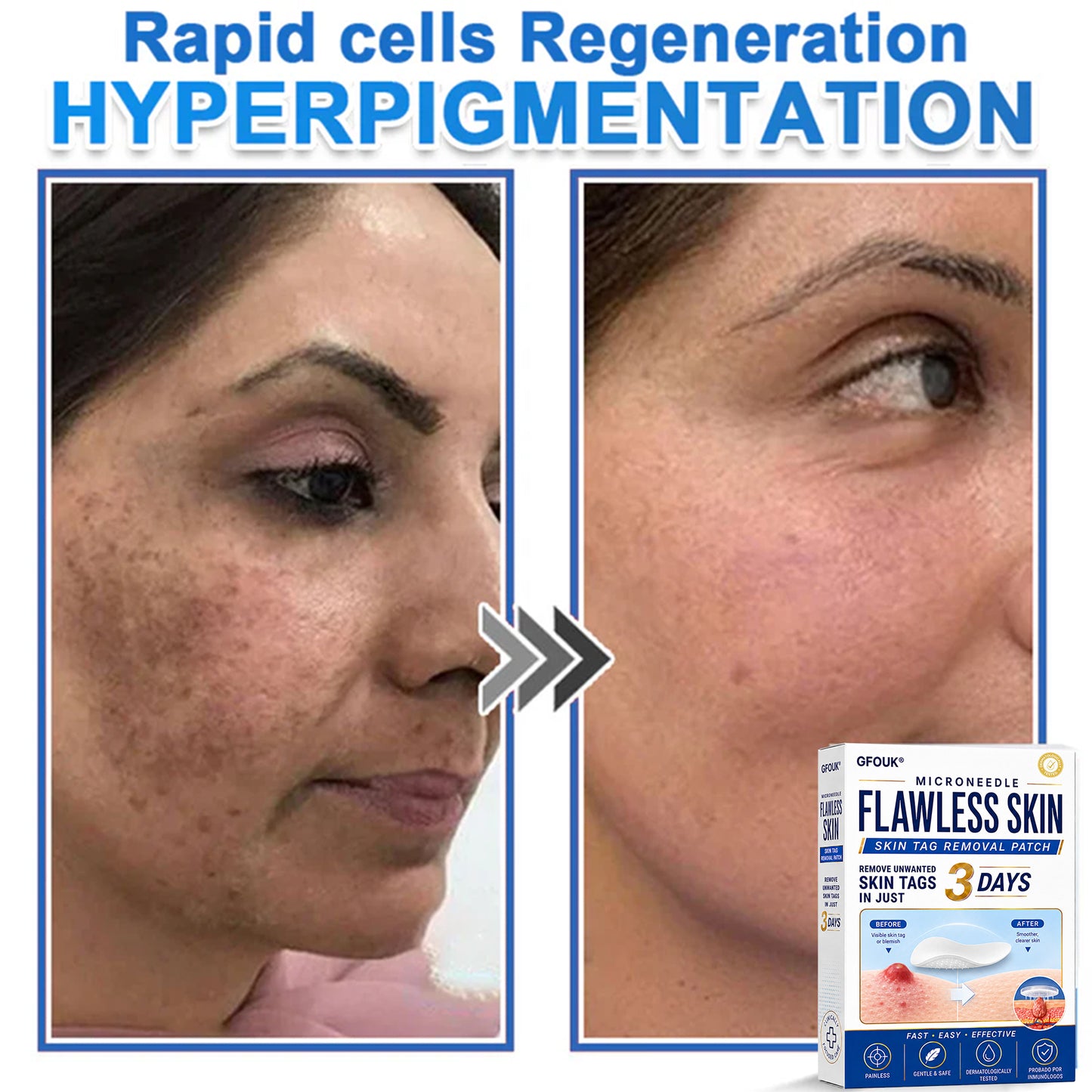 🔥GFOUK® 2026 Newly Upgraded 2-in-1 Microneedle Hydrocolloid Patches | Removes Raised Moles, Acne, Flat Warts, and Skin Tags | Improves Wrinkles, Scars, and Blemishes | Invisible Acne Patches for Face & Body
