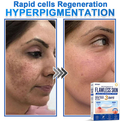 🔥GFOUK® 2026 Newly Upgraded 2-in-1 Microneedle Hydrocolloid Patches | Removes Raised Moles, Acne, Flat Warts, and Skin Tags | Improves Wrinkles, Scars, and Blemishes | Invisible Acne Patches for Face & Body